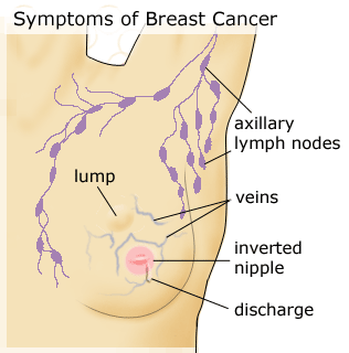 Breast Cancer
