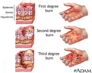 Burn Degree
