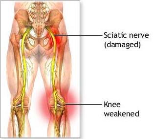 sciatic