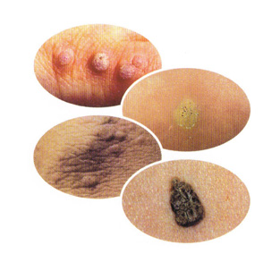 warts
