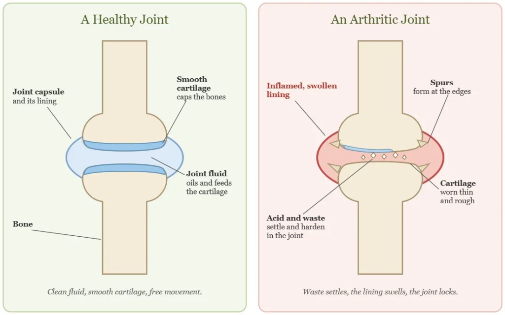 Diagram comparing a healthy joint with an arthritic joint.