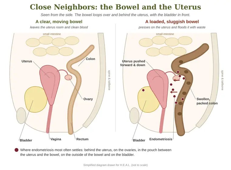 Side-view diagram of the pelvis: on the left a clear bowel leaves the uterus room; on the right a swollen, packed colon presses on the uterus, pushing it forward and down, with spots of endometriosis behind the uterus, on the ovary, on the bowel and on the bladder.