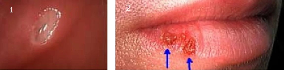 A canker sore inside the lip, and cold sores on the edge of the lip.