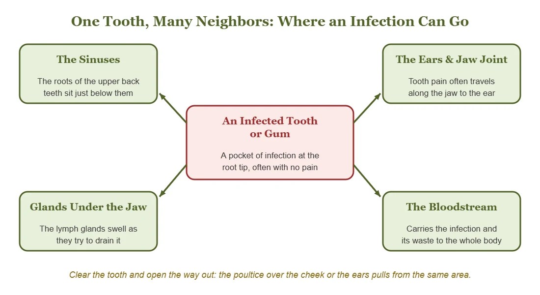 Diagram: an infection in a tooth or gum can travel to the sinuses, the ears and jaw joint, the glands under the jaw, and the bloodstream.