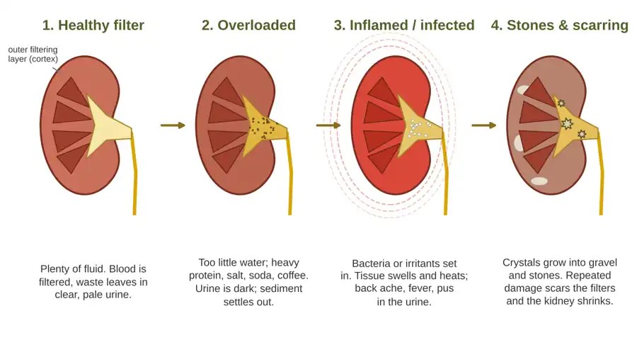 Diagram of four kidneys showing how kidney trouble builds: healthy filter, overloaded, inflamed or infected, and stones and scarring