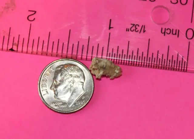 A jagged kidney stone about 3/8 inch across beside a dime and a ruler