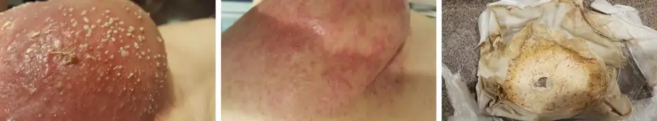 A member’s poke root poultice: the breakout of sores, the skin calming between rounds, and the used poultice