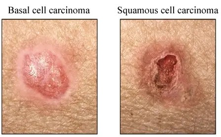 Left, basal cell carcinoma: a pink, pearly, raised spot. Right, squamous cell carcinoma: a rough, crusted sore.