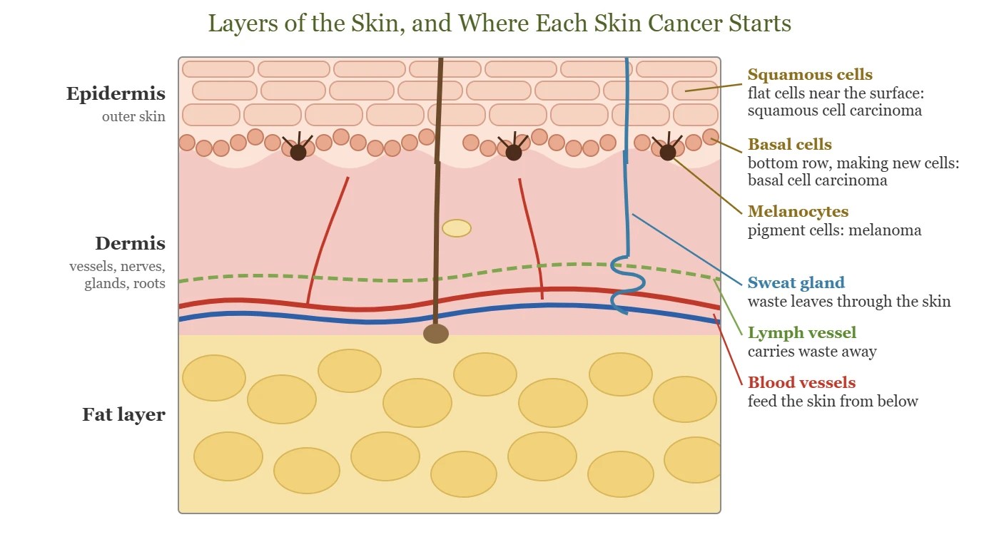 Diagram of the layers of the skin showing where basal cell, squamous cell and melanoma start
