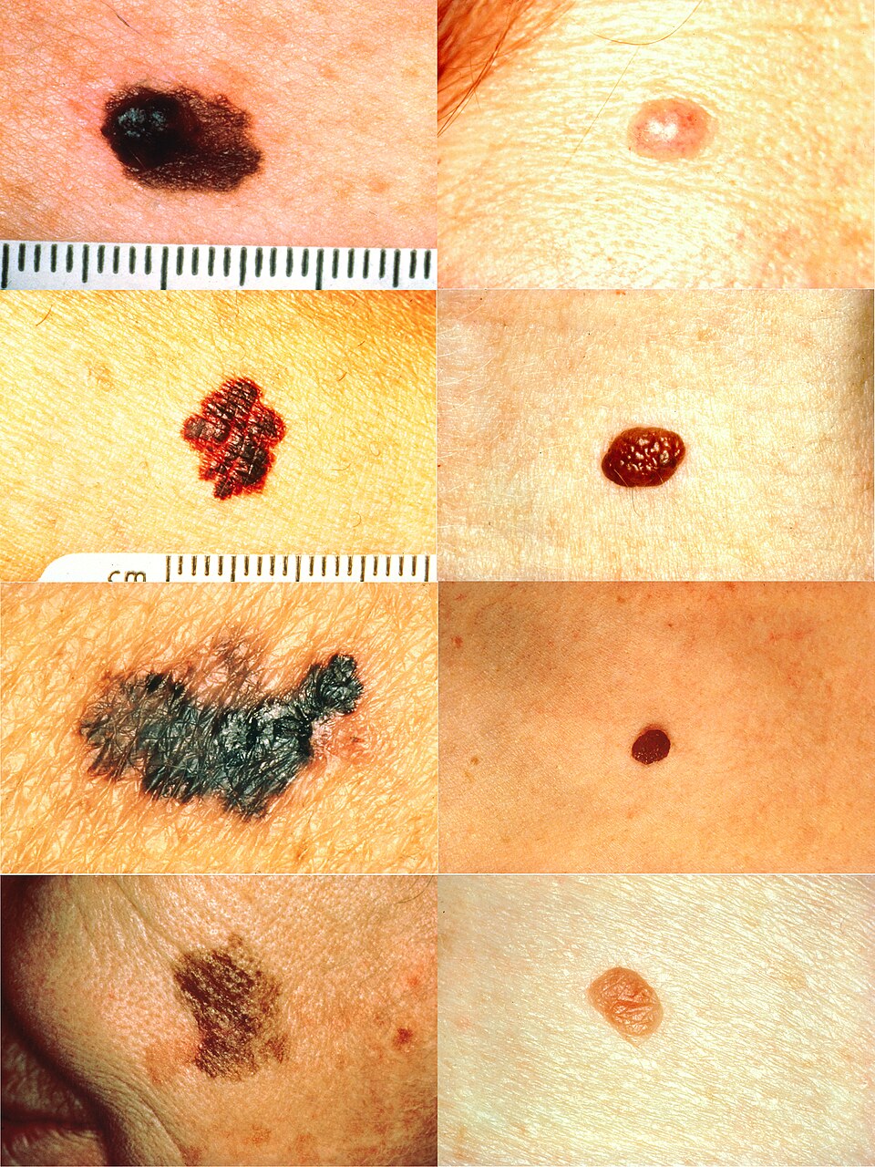 Melanomas on the left beside normal moles on the right for Asymmetry, Border, Color and Diameter