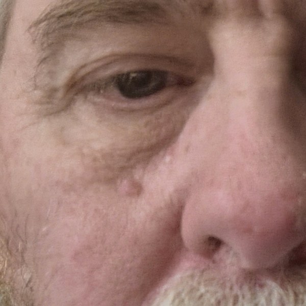 A small pale bump beside the nose, April 2025