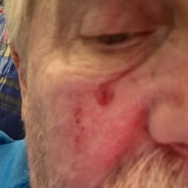 The spot open beside the nose, October 17, 2025