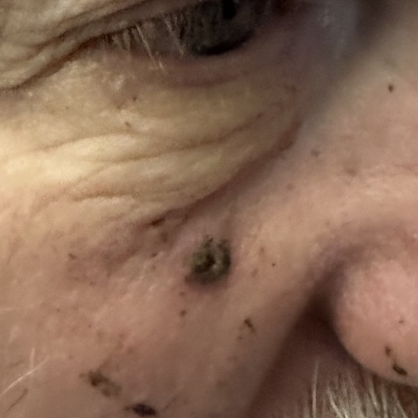 The spot crusted over under the poultice, October 25, 2025
