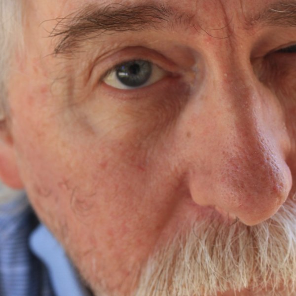 The cheek beside the nose healed, October 2026